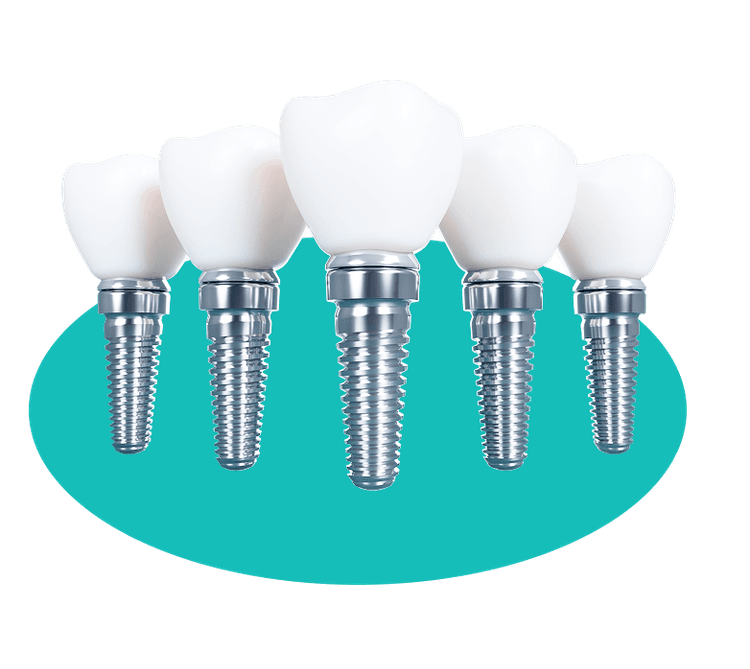 Implants